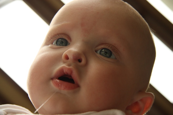 Nasal Tip Hemangioma
